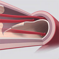 CEPA Webinar-Spontaneous Coronary Artery Dissection